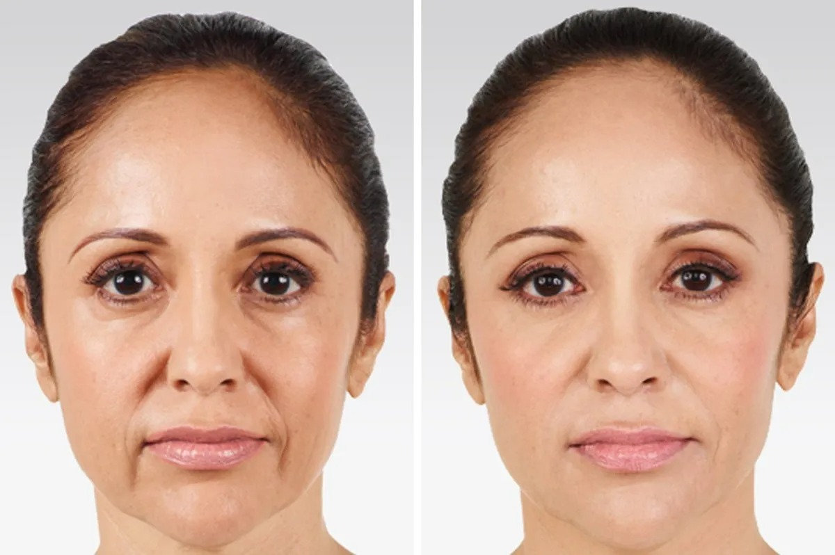 Allergan